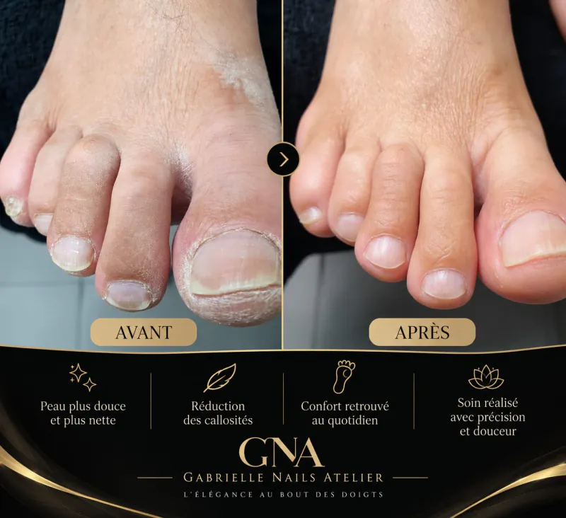 Avant / après d’une beauté des pieds russe : orteils et cuticules desséchés, puis peau nette et ongles soignés