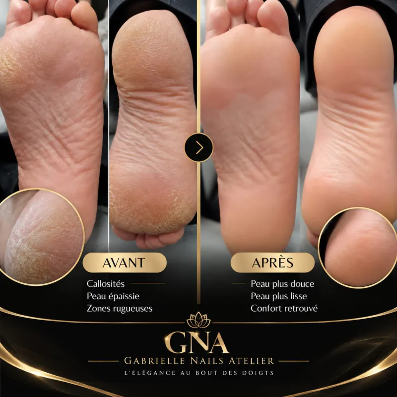 Avant / après d’un soin des callosités : talons épaissis et rugueux, puis peau lisse